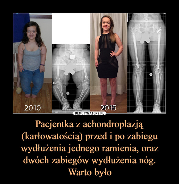 Pacjentka z achondroplazją (karłowatością) przed i po zabiegu wydłużenia jednego ramienia, oraz dwóch zabiegów wydłużenia nóg.Warto było –  