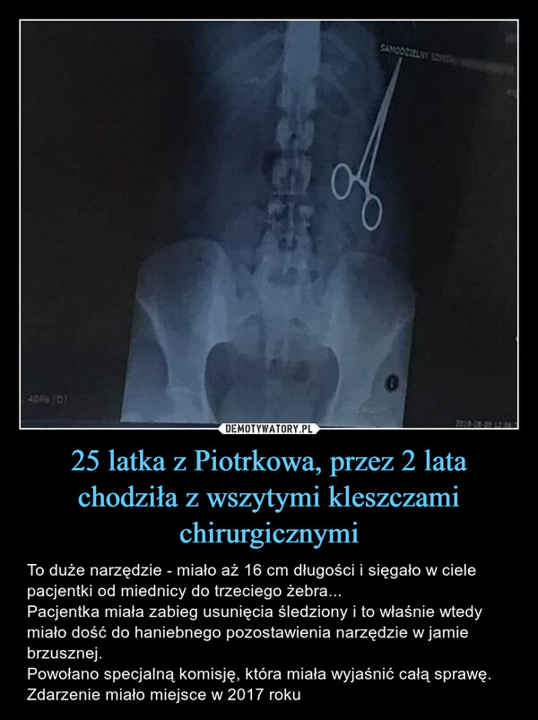 25 latka z Piotrkowa, przez 2 lata chodziła z wszytymi kleszczami chirurgicznymi